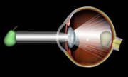 Eye's vision when impaired with cataracts